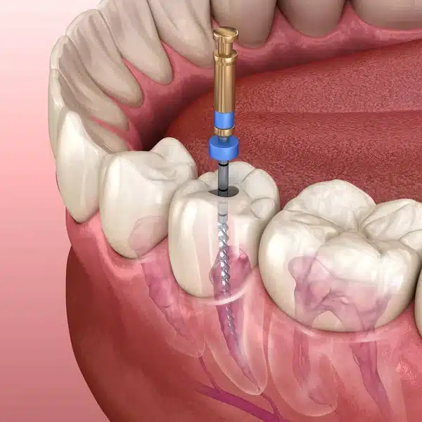 root canal treatment at West Covina dental